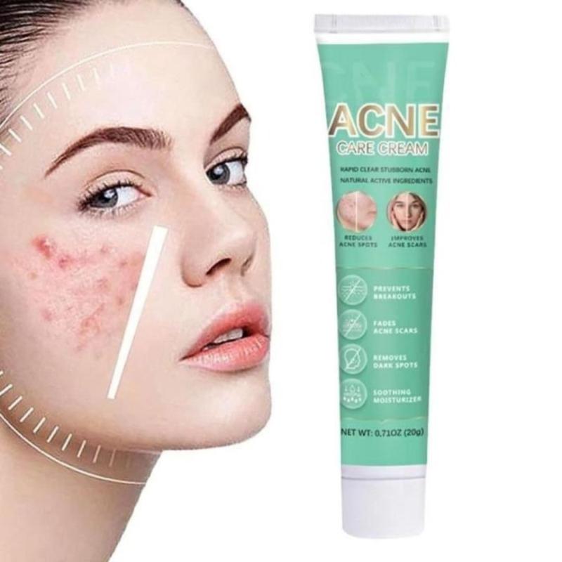 HBESTY Гель для лица, лечение акне и прыщей 20 г