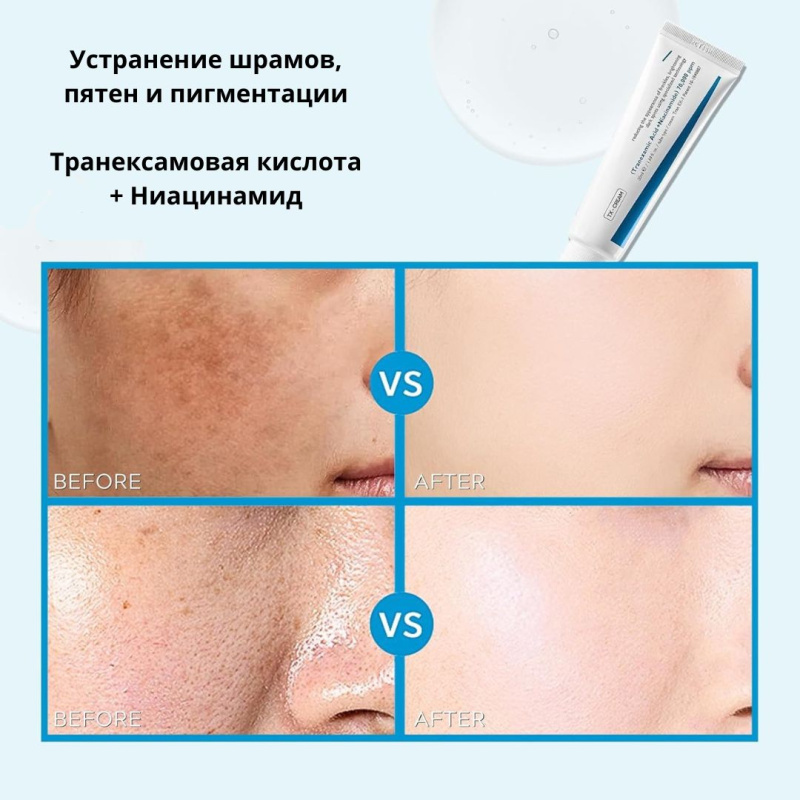 YOOJ Крем для лица от пигментных пятен, содержащий ниацинамид и транексамовую кислоту, предназначен для удаления веснушек, гиперпигментации, возрастных пятен, дефектов кожи, мелазмы. 50 мл.