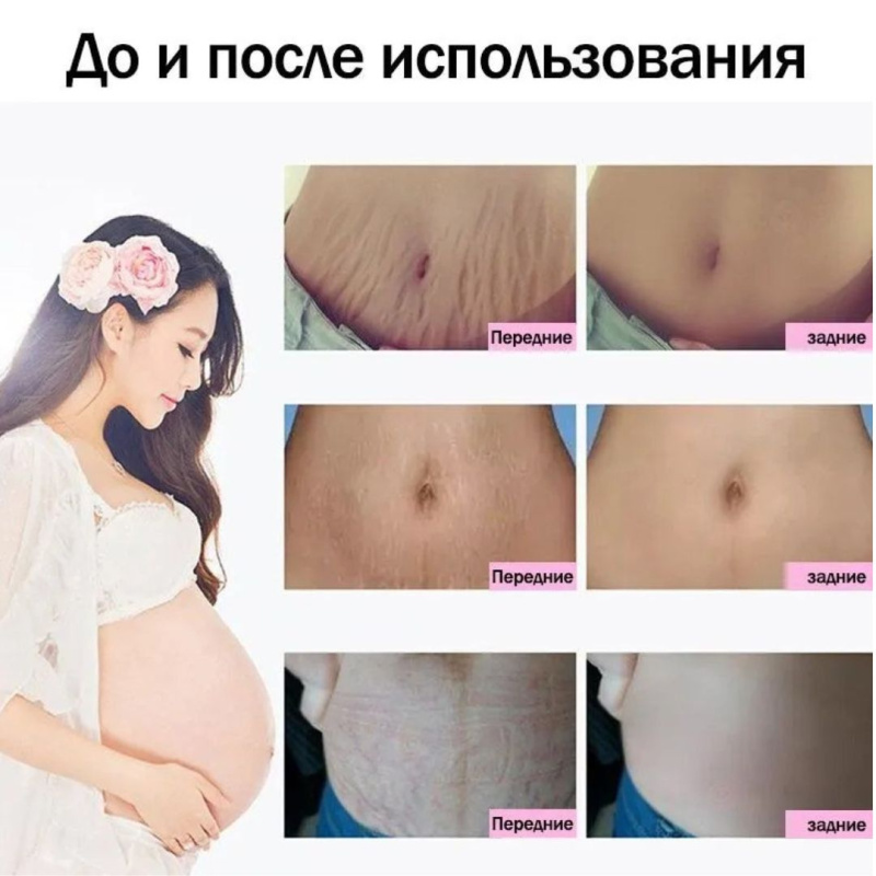 Anti-Stretch Mark Cream от Растяжек и Рубцов до и после родов, 60 г