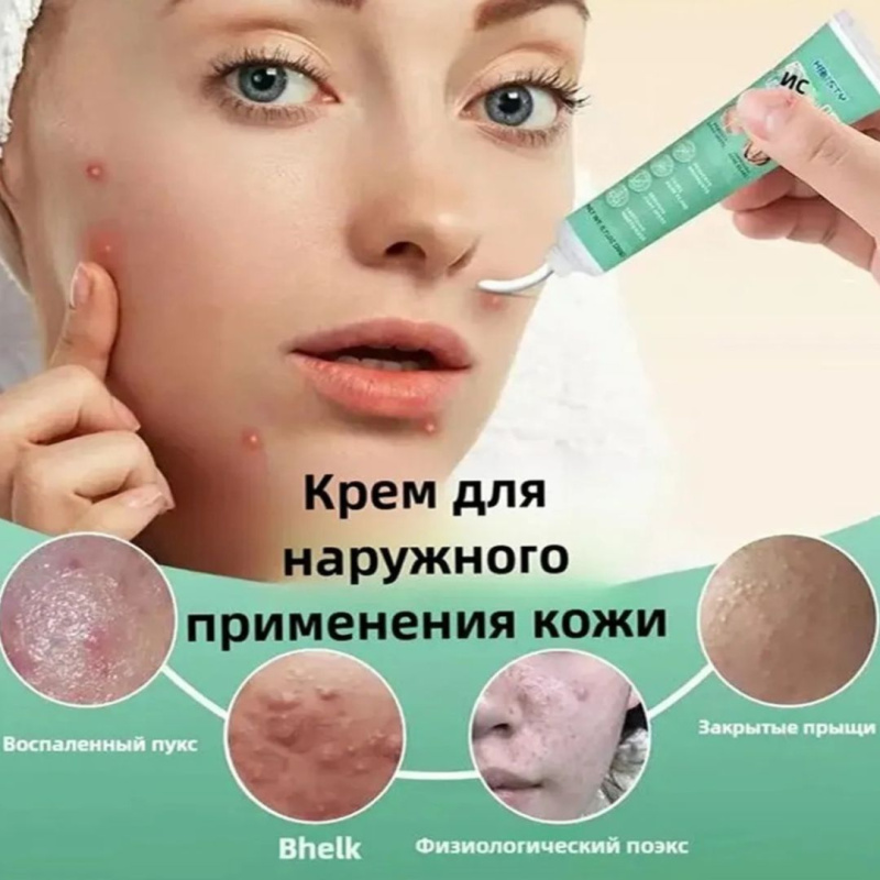 HBESTY Гель для лица, лечение акне и прыщей 20 г