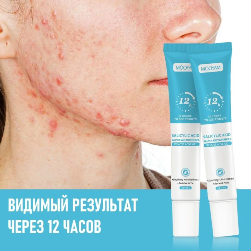 MOOYAM Точечный крем-гель от прыщей и акне для проблемной кожи лица 20гр.